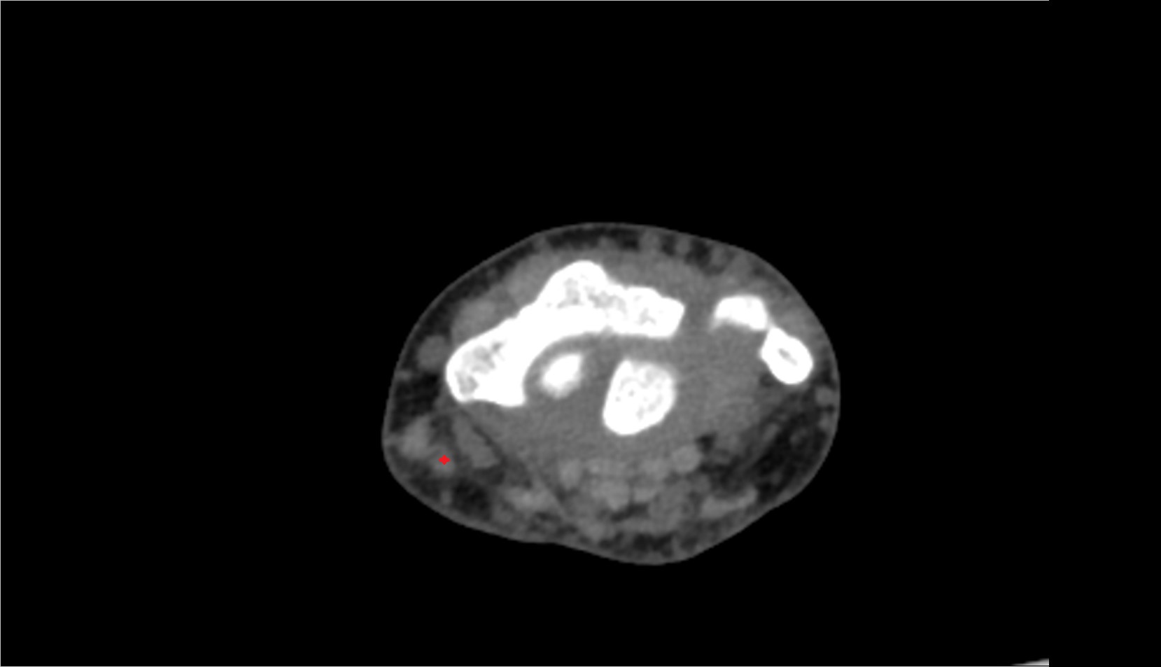 Abductor pollicis longus tendon ct axial 2
