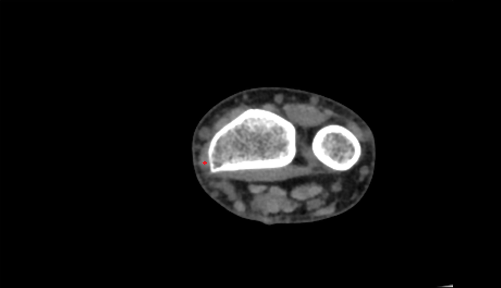 Abductor pollicis longus tendon ct axial 3