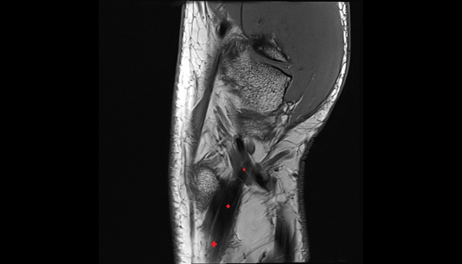 Abductor pollicis longus tendon sag cross sectional anatomy 3T MRI AI enhanced radiology image-img-00000-00000