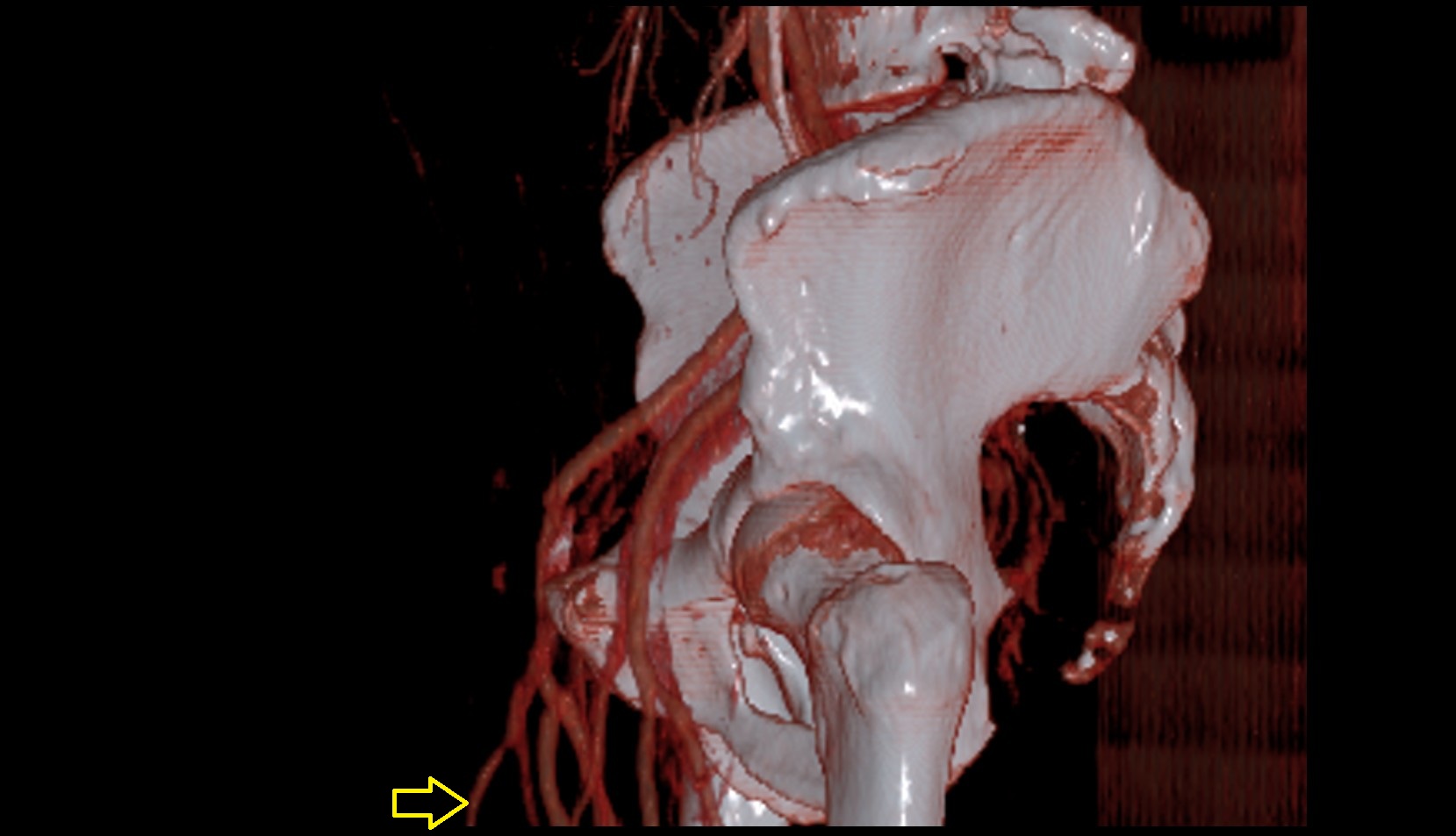 Accessory Saphenous Vein 3D