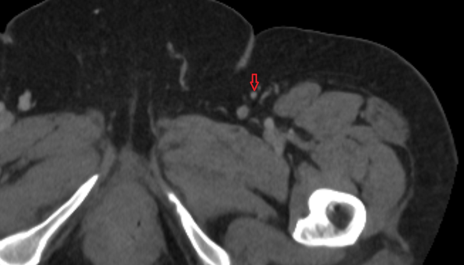 Accessory Saphenous Vein CT  axial  anatomy  image-img-00000-00000