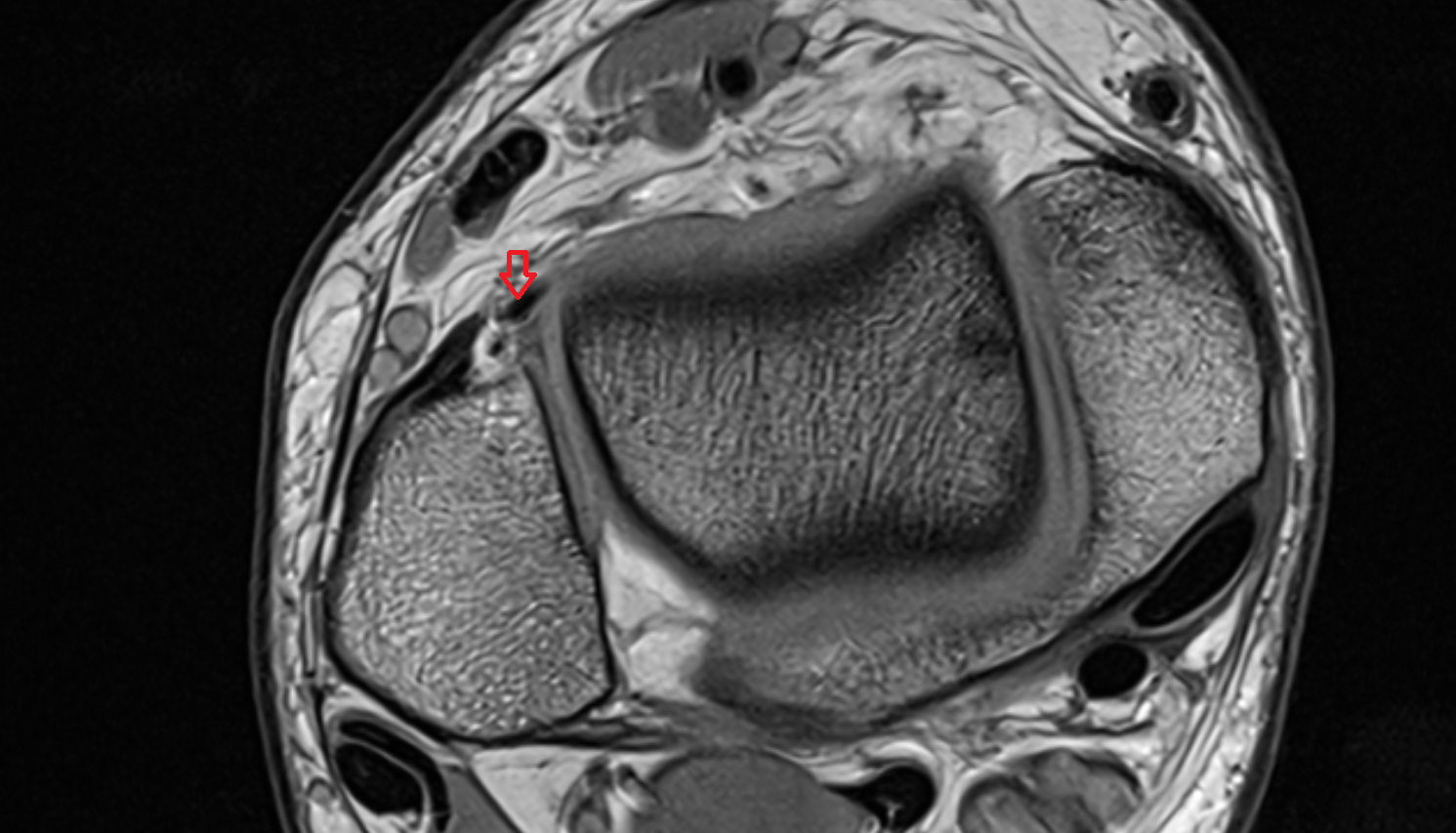 Accessory anterior inferior tibiofibular (Bassett’s) ligament AXIAL cross sectional anatomy 3T MRI AI enhanced radiology image-img-00000-00000_00001