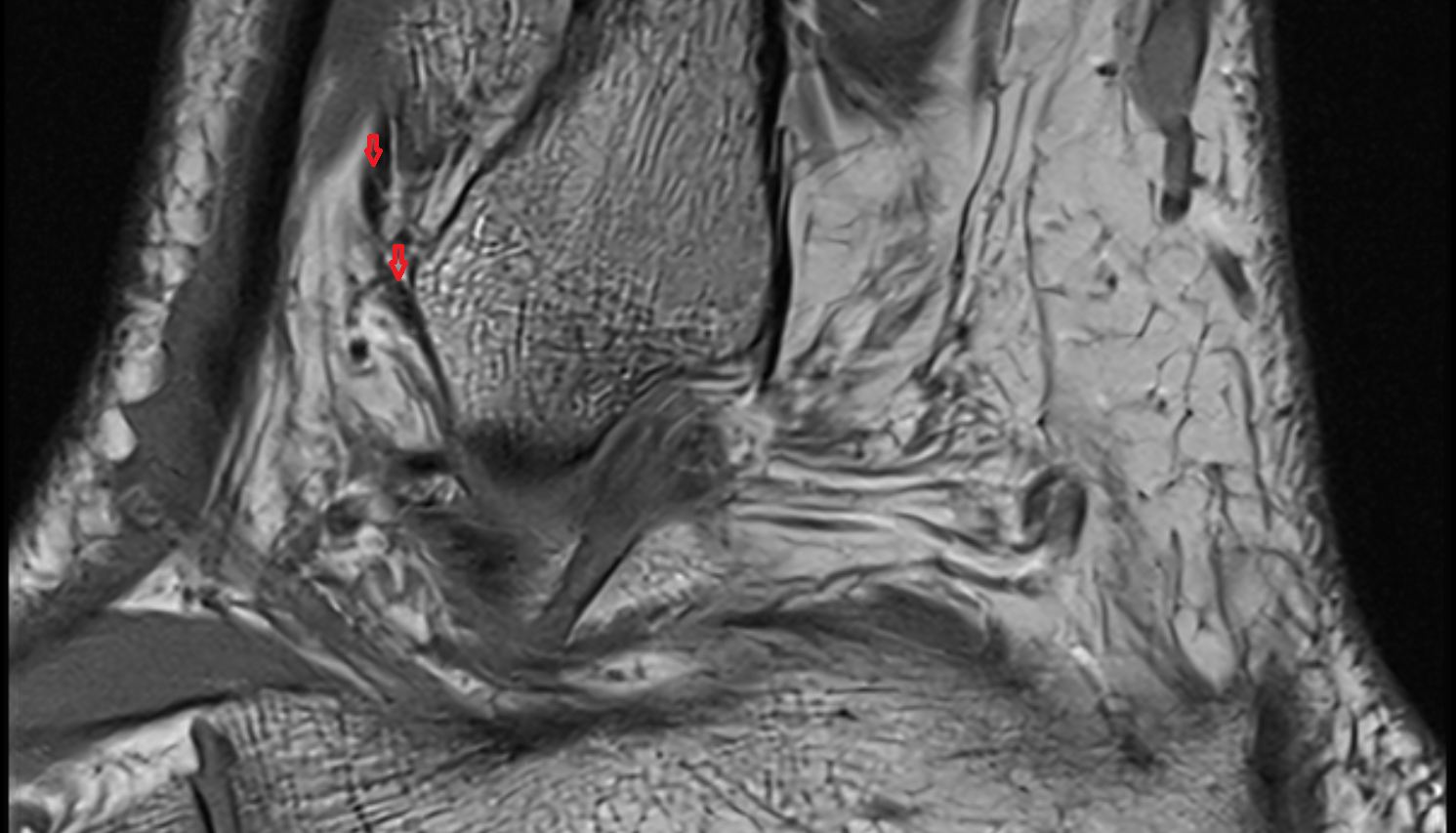 Accessory anterior inferior tibiofibular (Bassett’s) ligament SAG cross sectional anatomy 3T MRI AI enhanced radiology image-img-00000-00000_00001