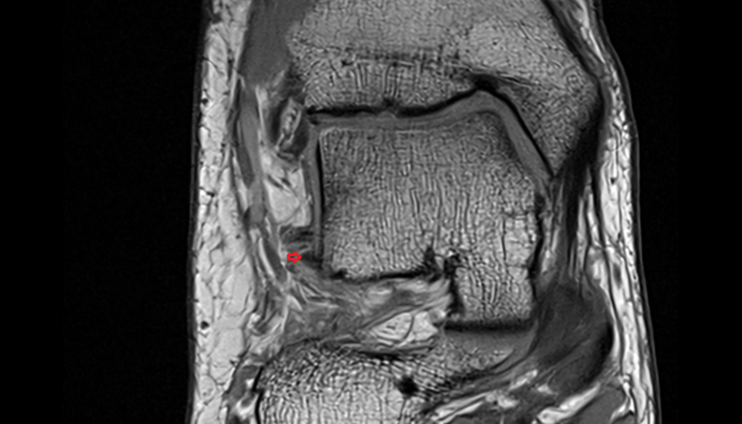 Accessory anterior inferior tibiofibular (Bassett’s) ligament coronal cross sectional anatomy 3T MRI AI enhanced radiology image-img-00000-00000