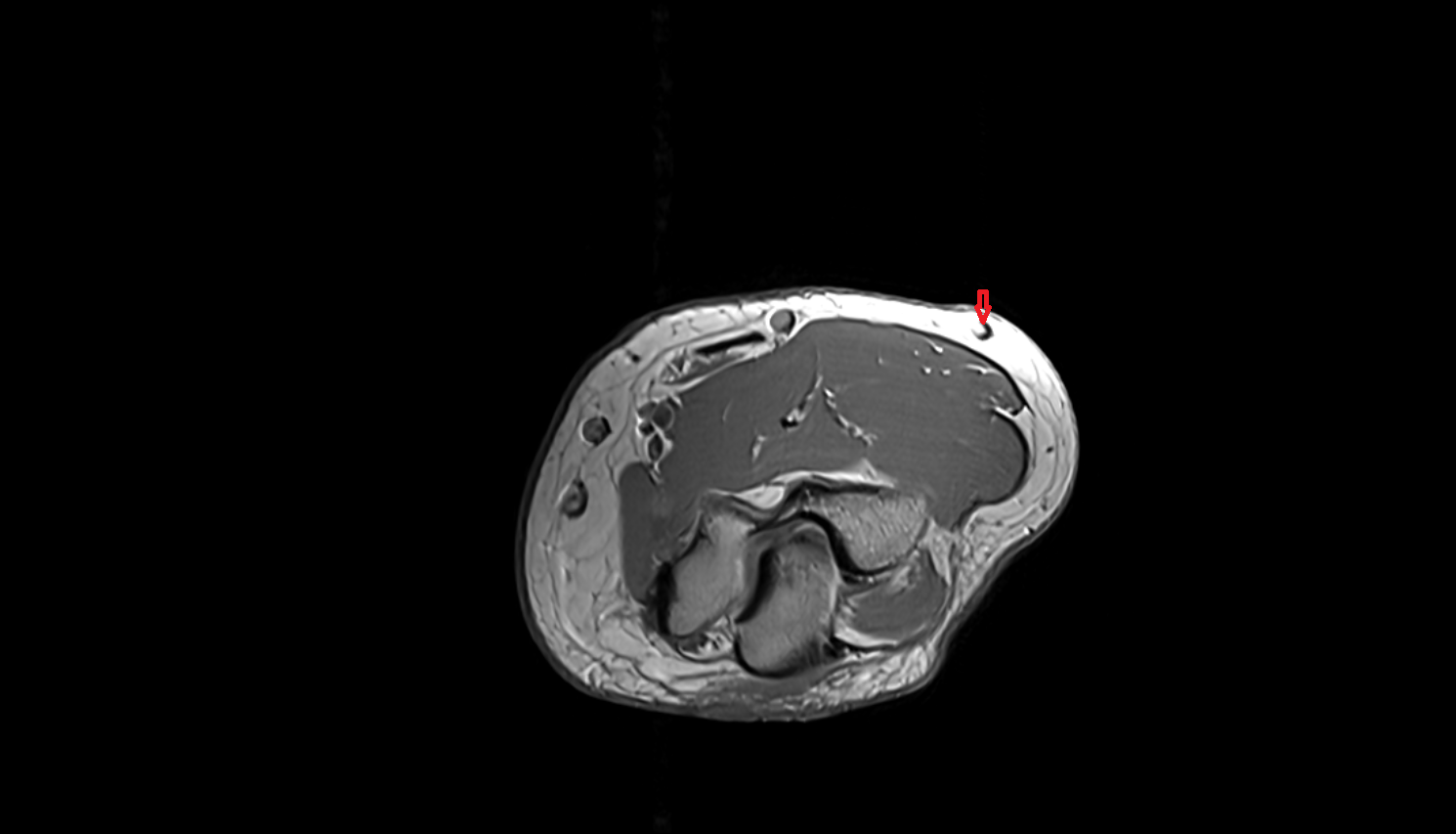 Accessory cephalic vein axial cross sectional anatomy 3T MRI AI enhanced radiology image -img-00000-00000_00001