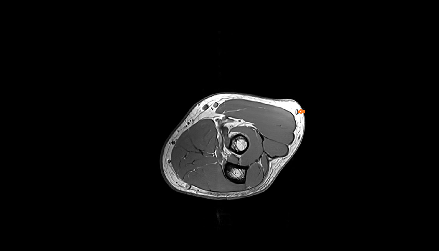 Accessory cephalic vein axial cross sectional anatomy 3T MRI AI enhanced radiology image -img-00000-00000_00002