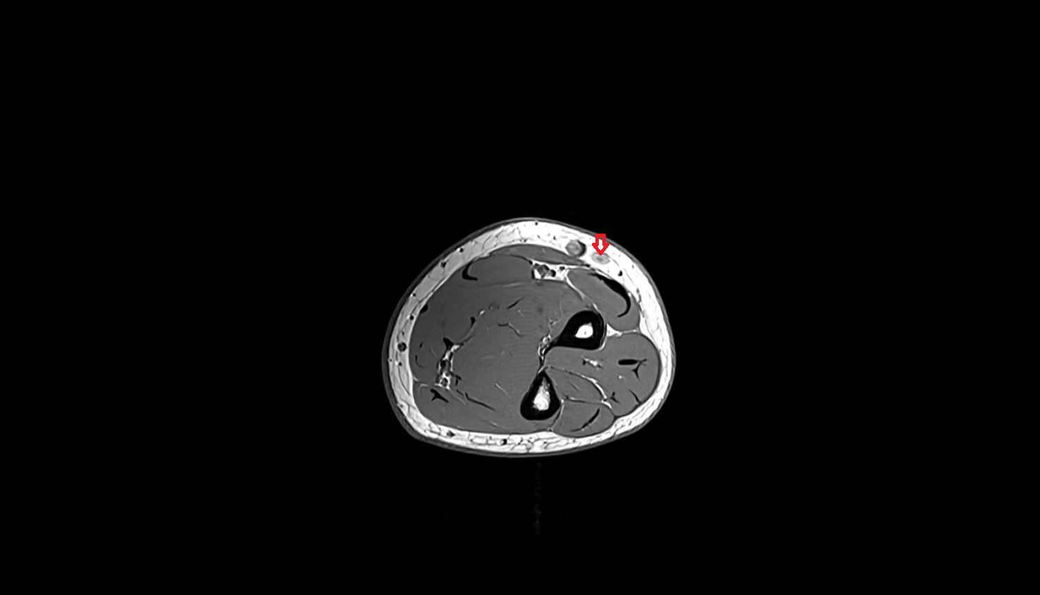 Accessory cephalic vein axial cross sectional anatomy 3T MRI AI enhanced radiology image -img-00000-00000_00003