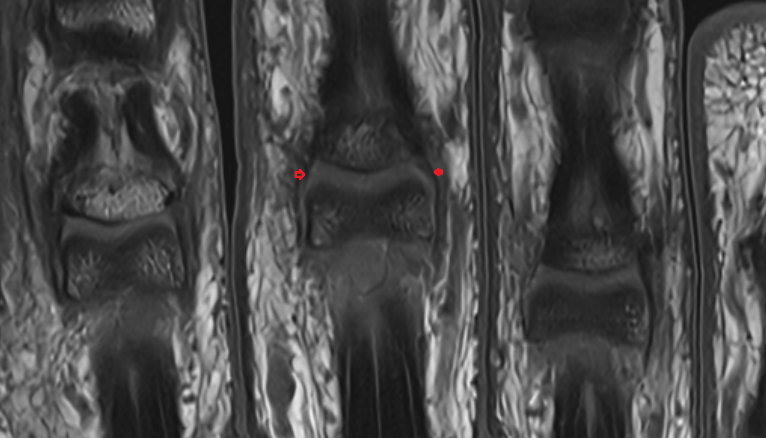 Accessory collateral ligament  HAND  MRI CORONAL image-img-00000-00000
