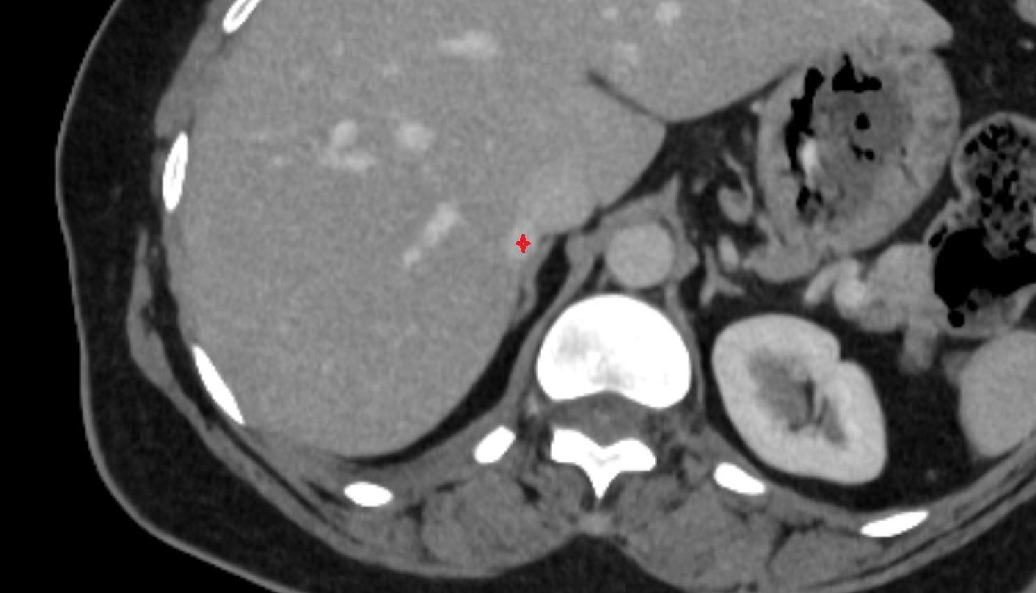 Accessory hepatic vein AXIAL CT  anatomy  image -img-00000-00000