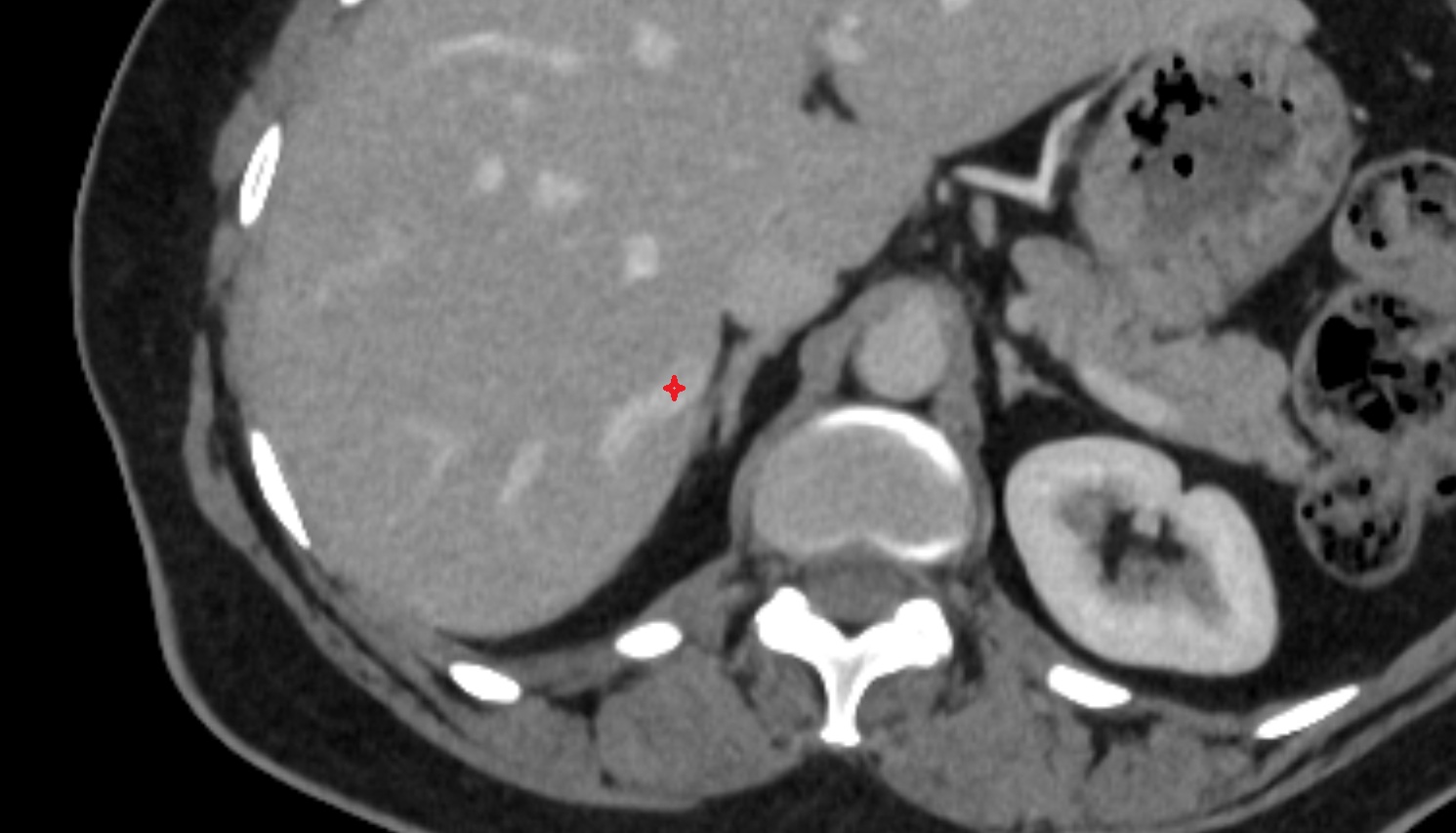 Accessory hepatic vein AXIAL CT  anatomy  image -img-00000-00000_00001