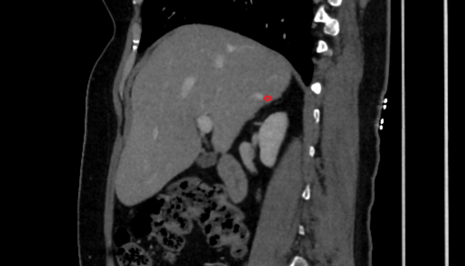 Accessory hepatic vein SAG CT  anatomy  image -img-00000-00000