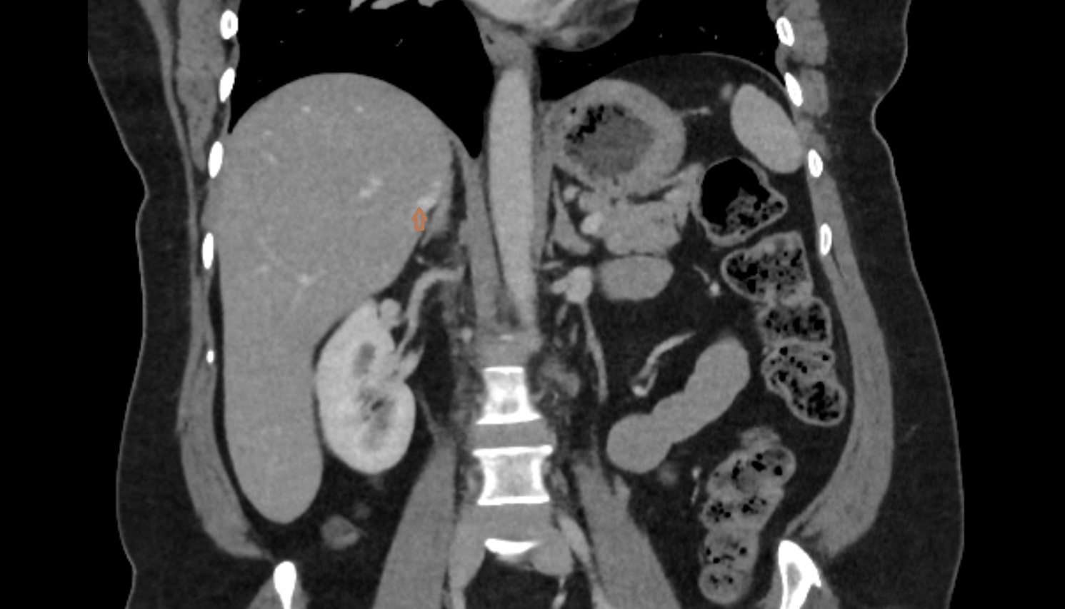 Accessory hepatic vein coronal CT  anatomy  image -img-00000-00000_00001