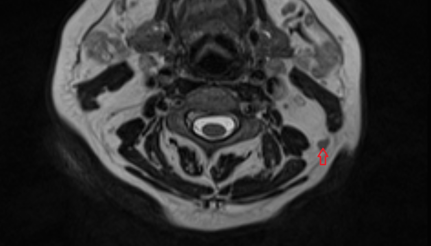 Accessory lymph nodes mri axial  image -img-00000-00000