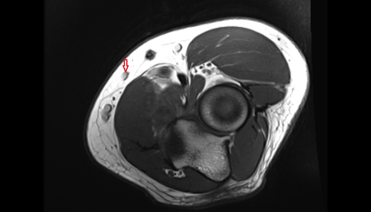 Accessory median cubital vein axial cross sectional anatomy 3T MRI AI enhanced radiology image -img-00000-00000
