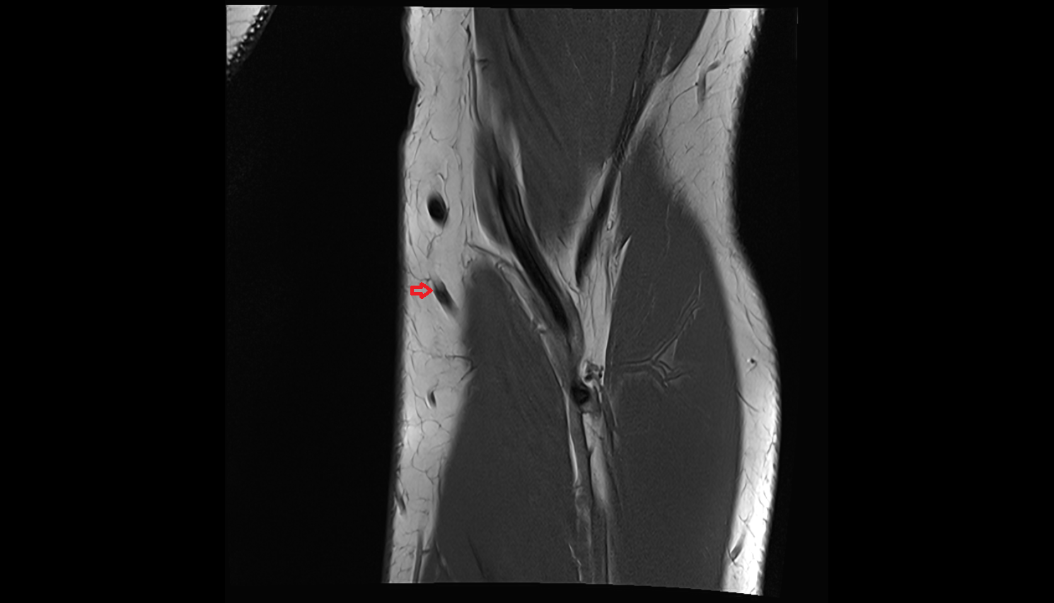 Accessory median cubital vein coronal cross sectional anatomy 3T MRI AI enhanced radiology image -img-00000-00000