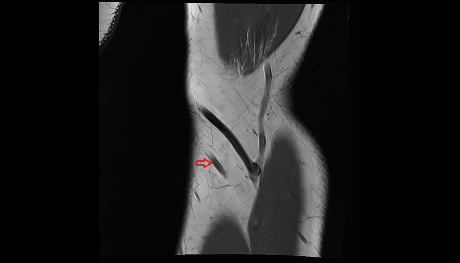 Accessory median cubital vein coronal cross sectional anatomy 3T MRI AI enhanced radiology image -img-00000-00000_00001