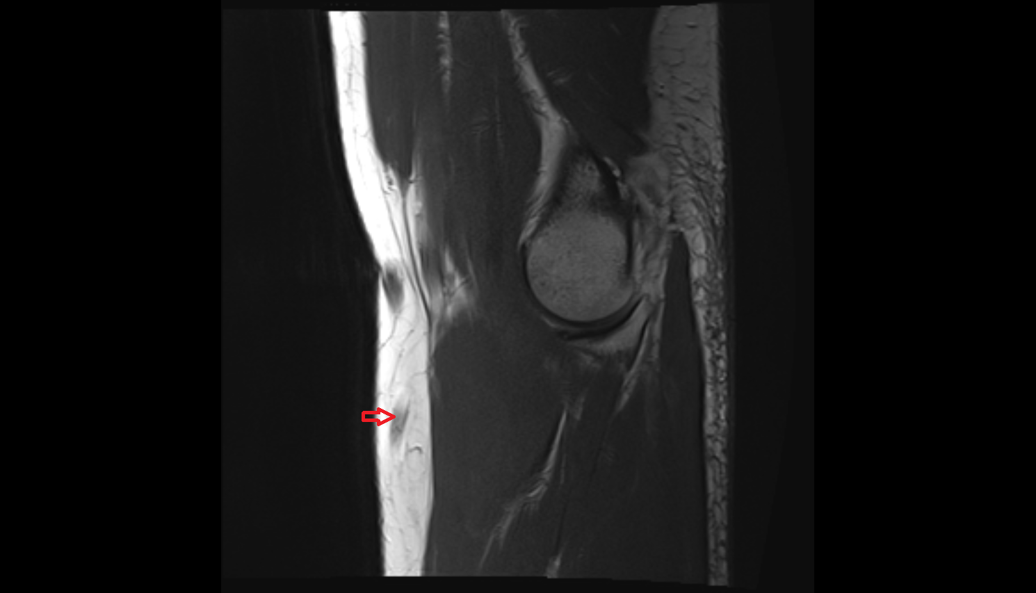 Accessory median cubital vein sag cross sectional anatomy 3T MRI AI enhanced radiology image -img-00000-00000