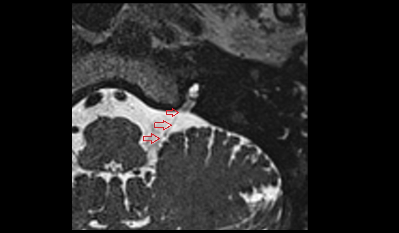 Accessory nerve (Cranial nerve XI) MRI 3T axial image