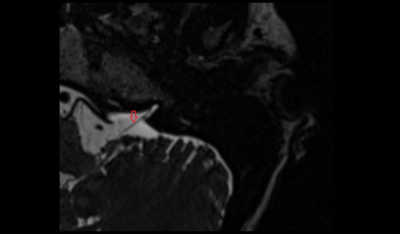 Accessory nerve (Cranial nerve XI) MRI 3T axial image 1