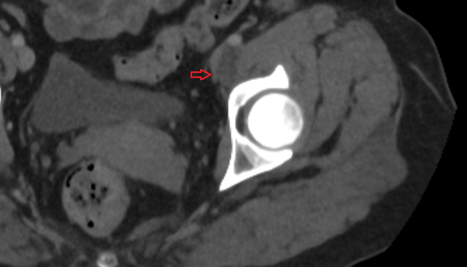 Accessory obturator artery  CT  axial  anatomy  image-img-00000-00000