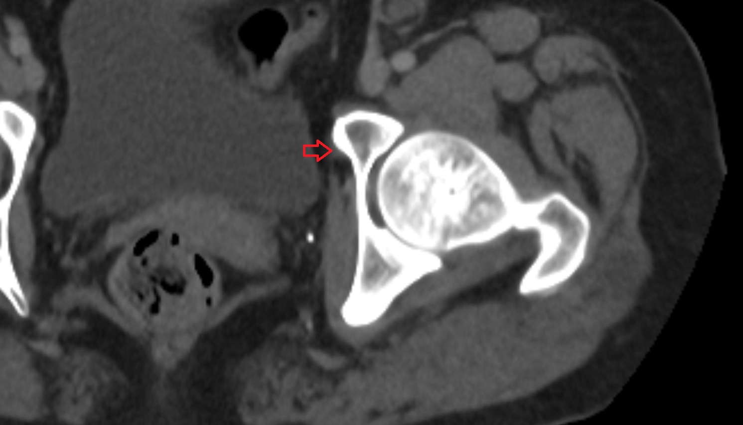 Accessory obturator artery  CT  axial  anatomy  image-img-00000-00000_00002