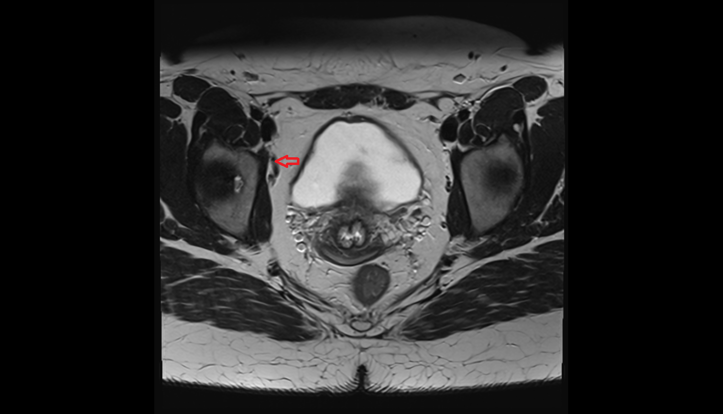 Accessory obturator vein  MRI axial image-img-00000-00000
