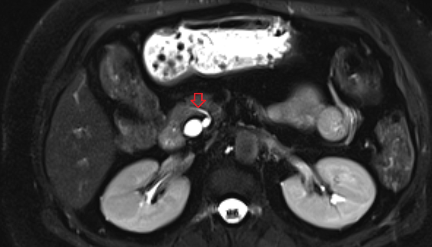 Accessory pancreatic duct  CT  axial  anatomy image-img-00000-00000