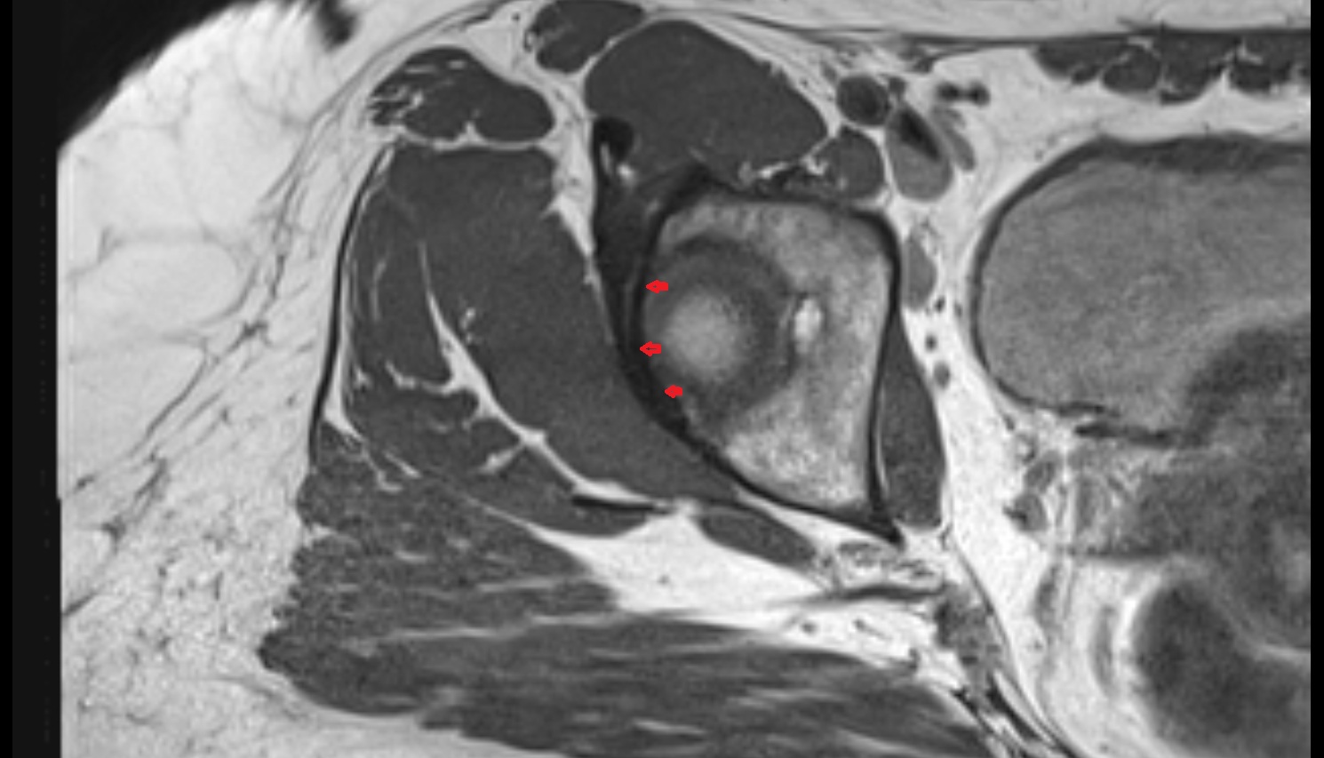 Acetabular labrum  MRI axial anatomy image-img-00000-00000