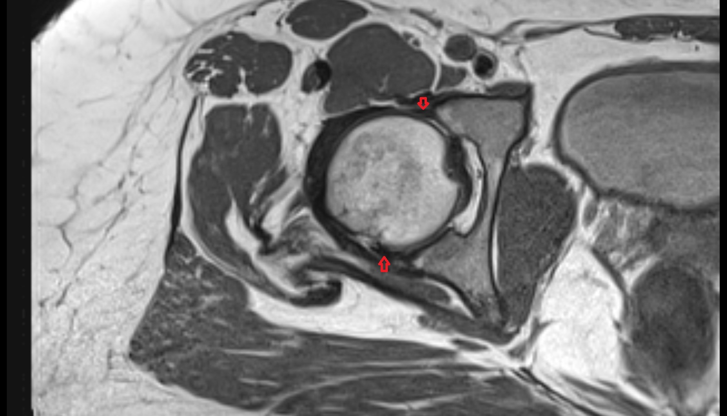 Acetabular labrum  MRI axial anatomy image-img-00000-00000_00001
