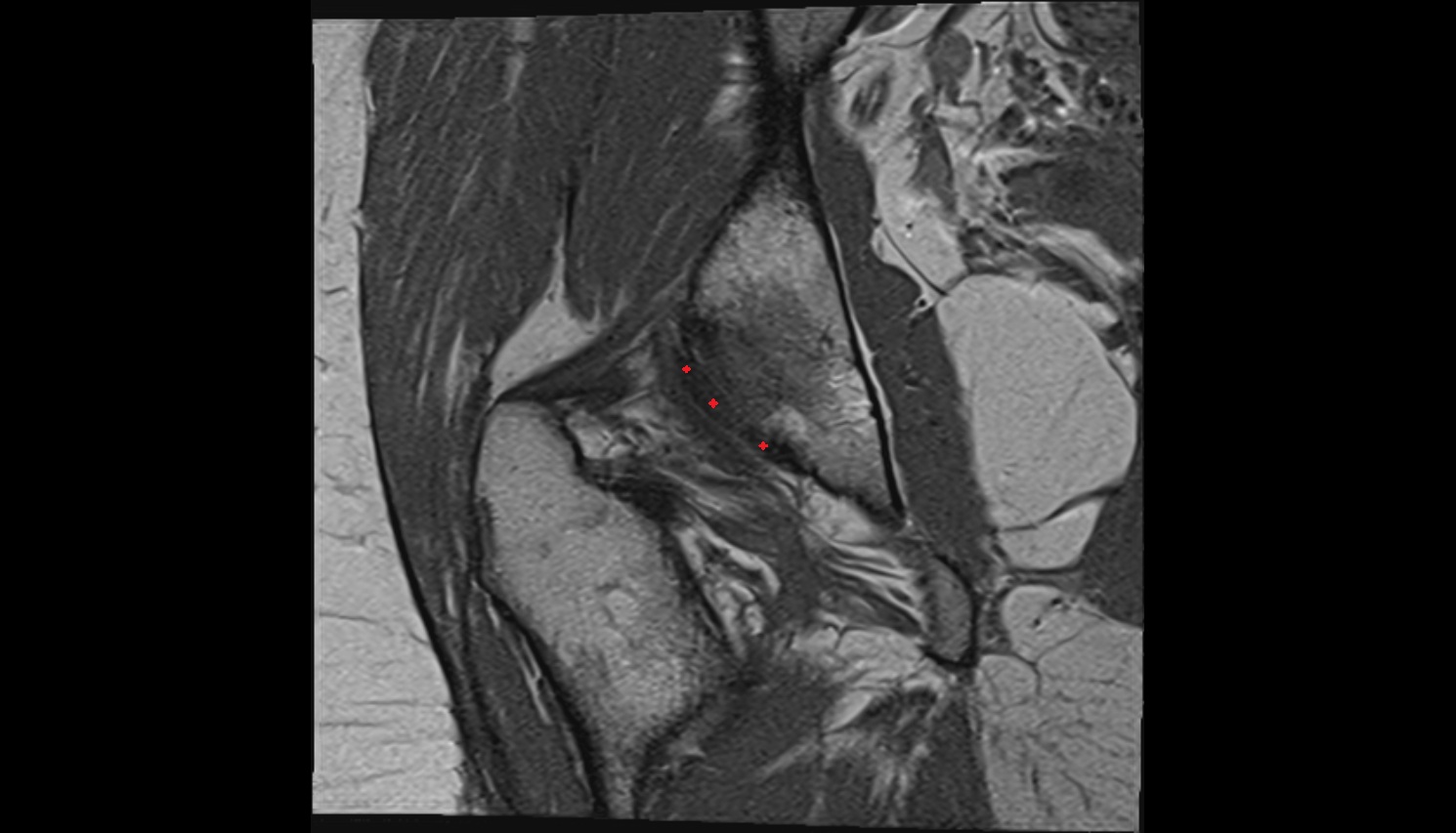 Acetabular labrum  MRI coronal  anatomy image-img-00000-00000