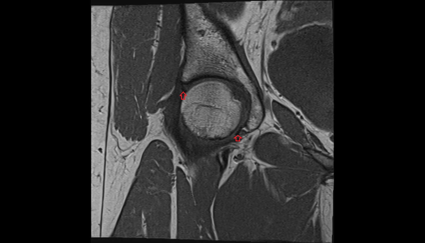 Acetabular labrum  MRI coronal  anatomy image-img-00000-00000_00001