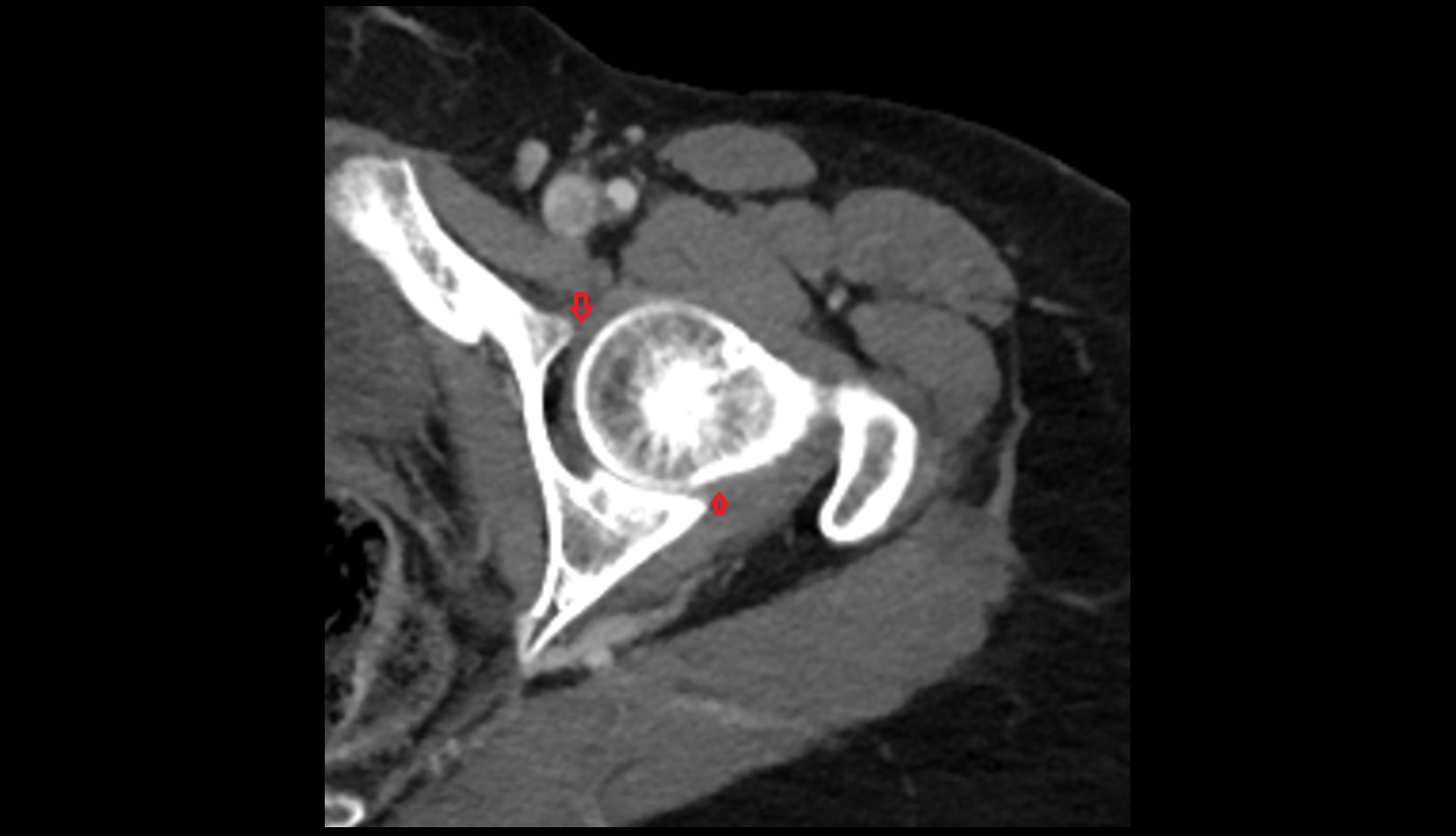 Acetabular labrum ct axial