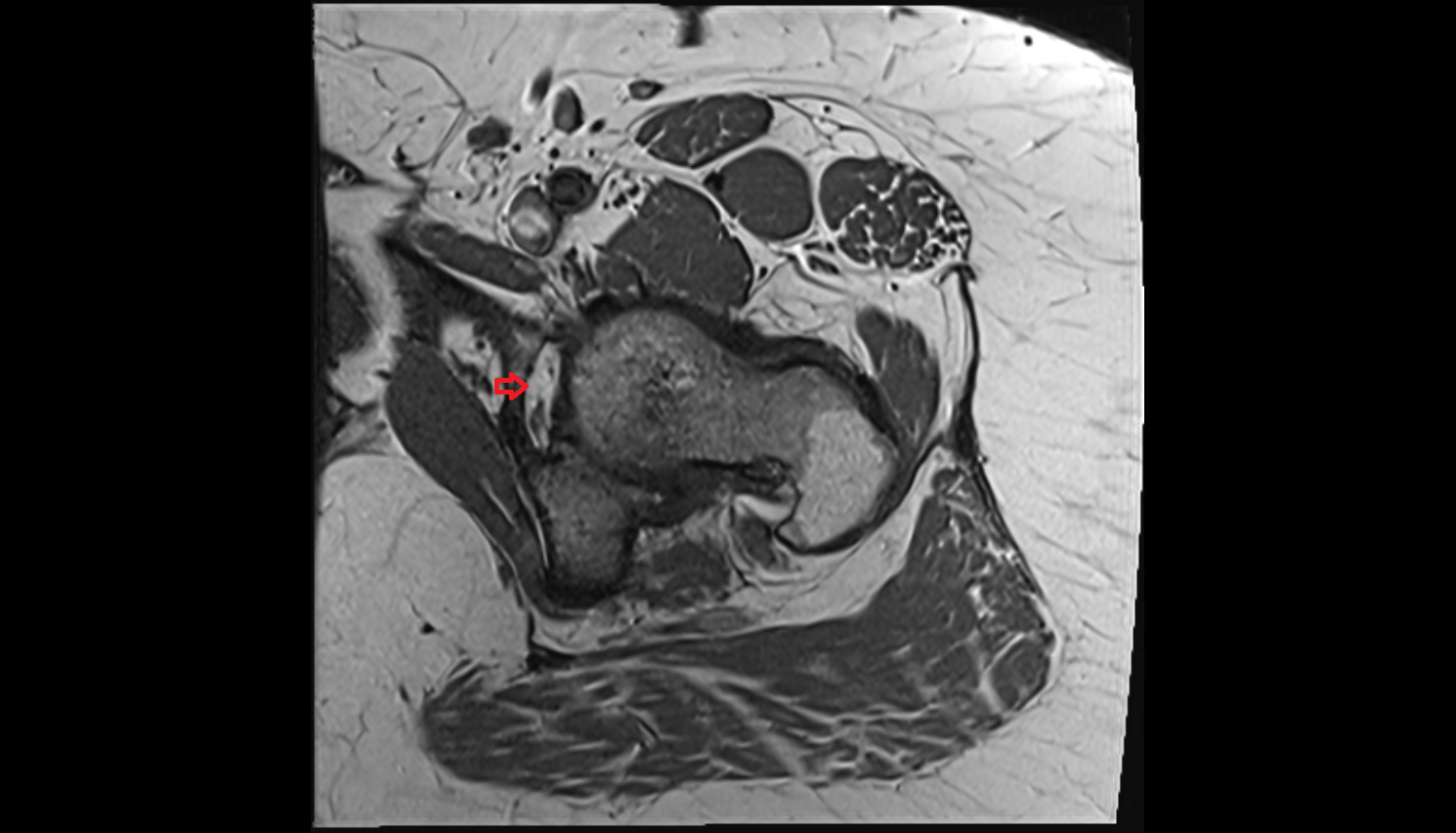 Acetabular notch  MRI axial image-img-00000-00000