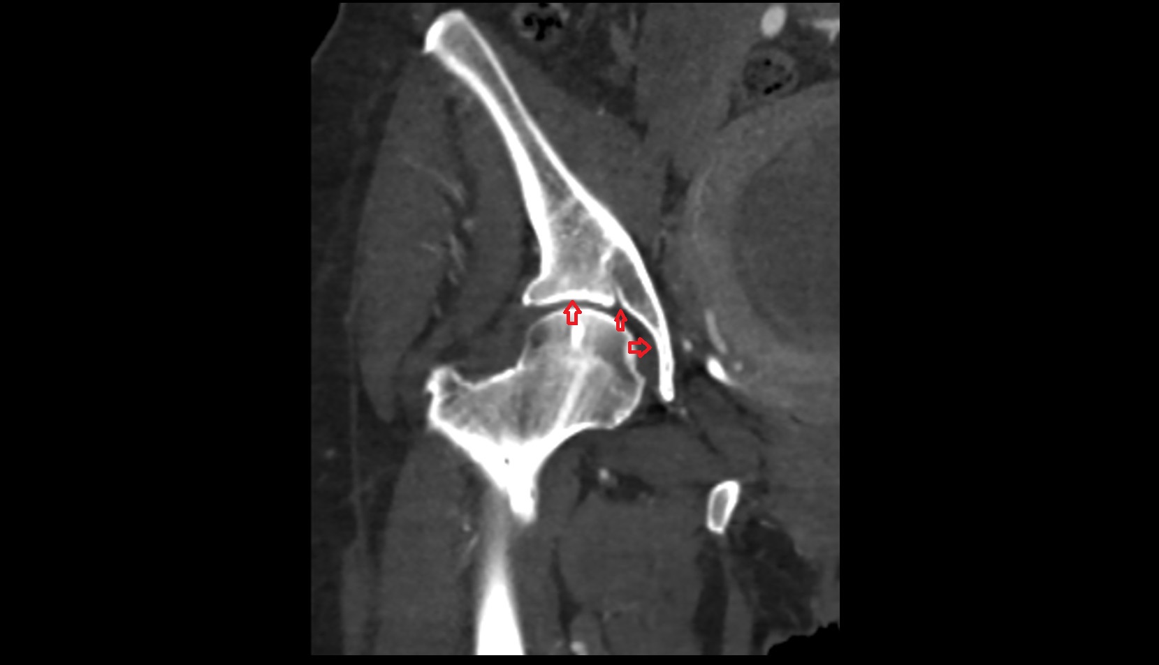 Acetabulum CT CORONAL
