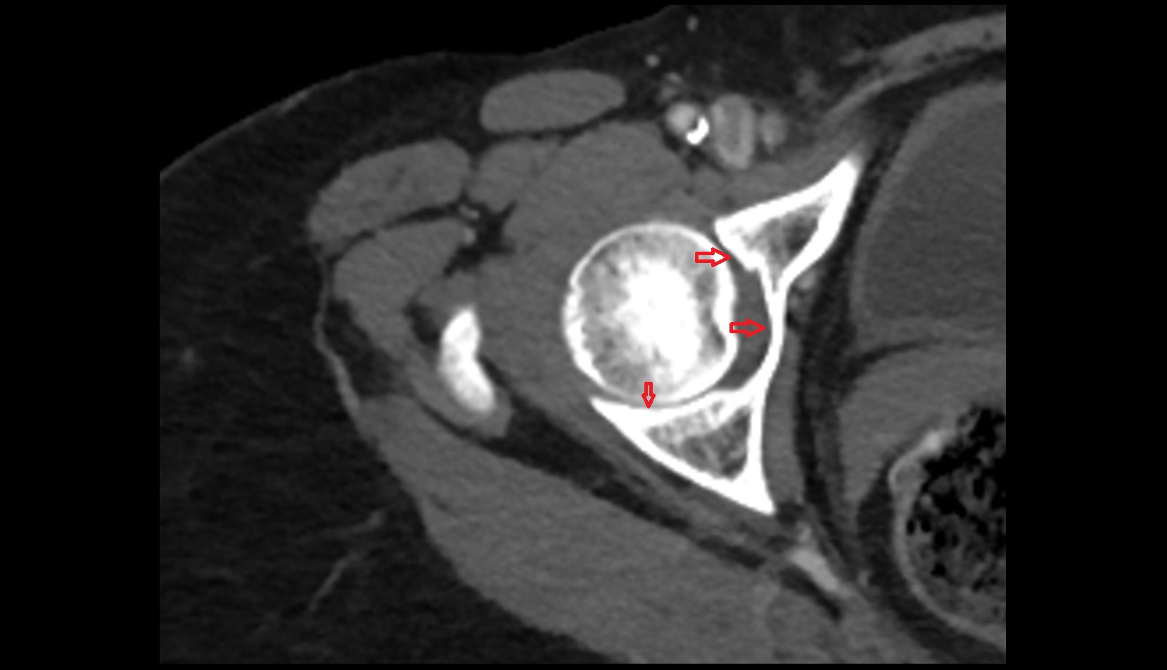 Acetabulum CT axial image