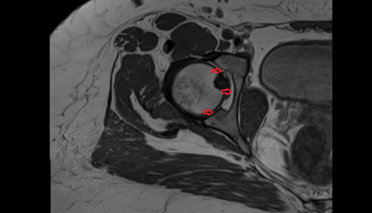 Acetabulum  MRI  axial  anatomy  image-img-00000-00000