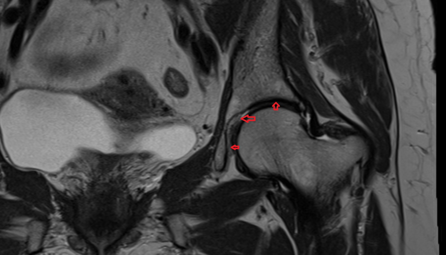 Acetabulum  MRI  coronal  anatomy  image-img-00000-00000