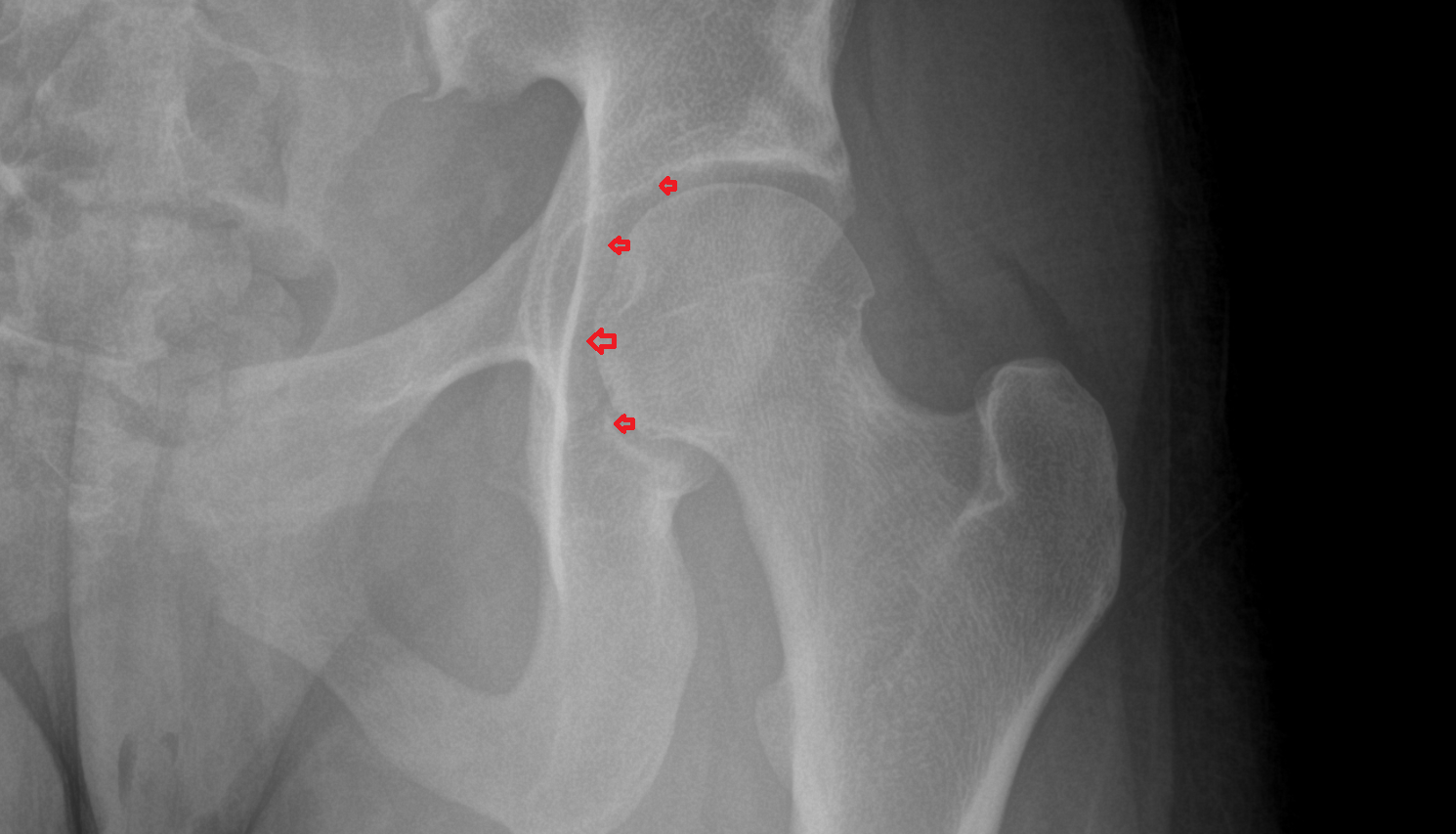 Acetabulum  x ray  anatomy labelled image-img-00000-00000