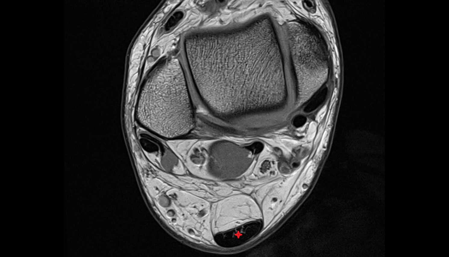 Achilles’ Tendon (Calcaneal Tendon)   axial cross sectional anatomy 3T MRI AI enhanced radiology image-img-00000-00000_00001