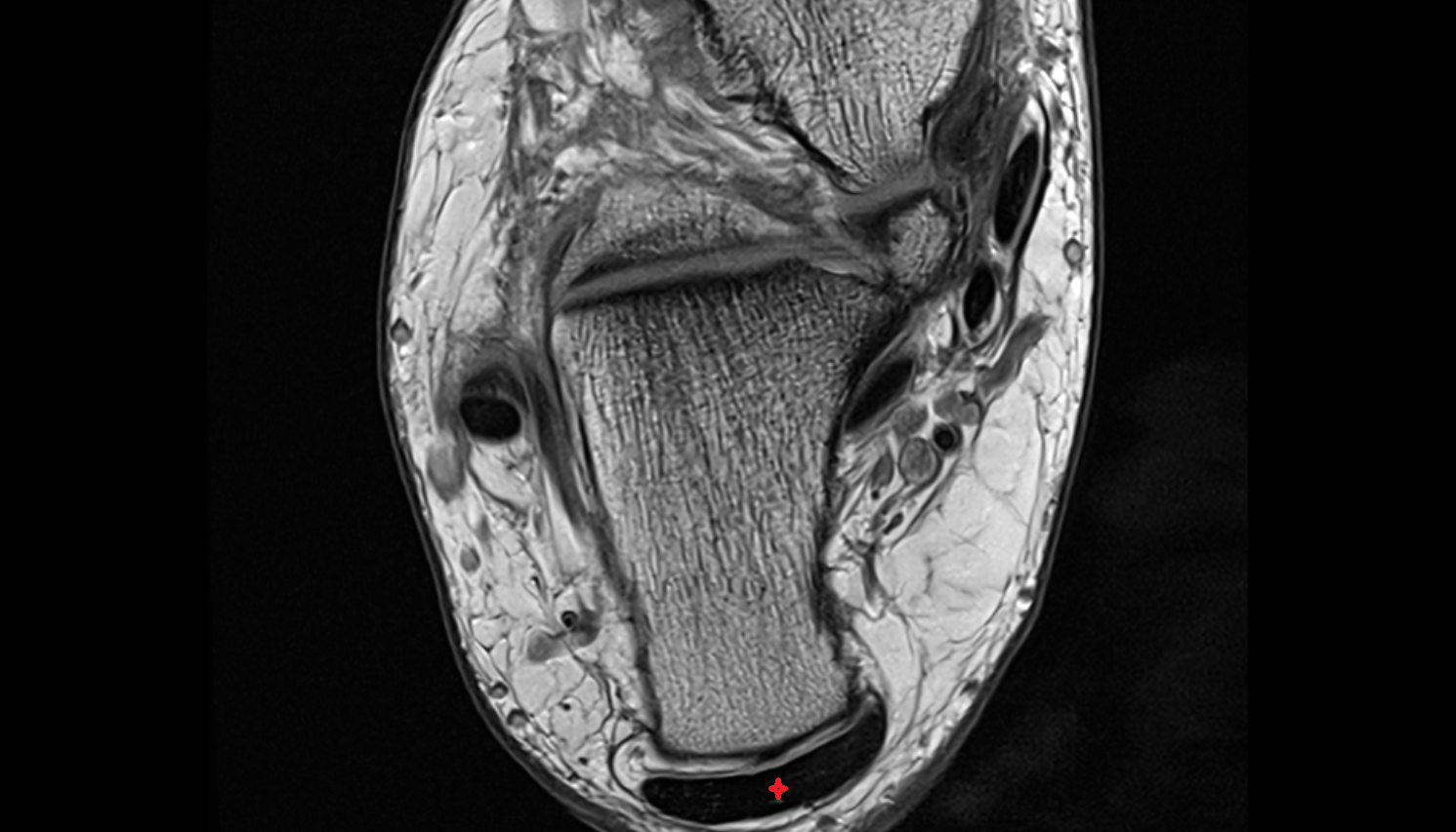 Achilles’ Tendon (Calcaneal Tendon)   axial cross sectional anatomy 3T MRI AI enhanced radiology image-img-00000-00000_00002