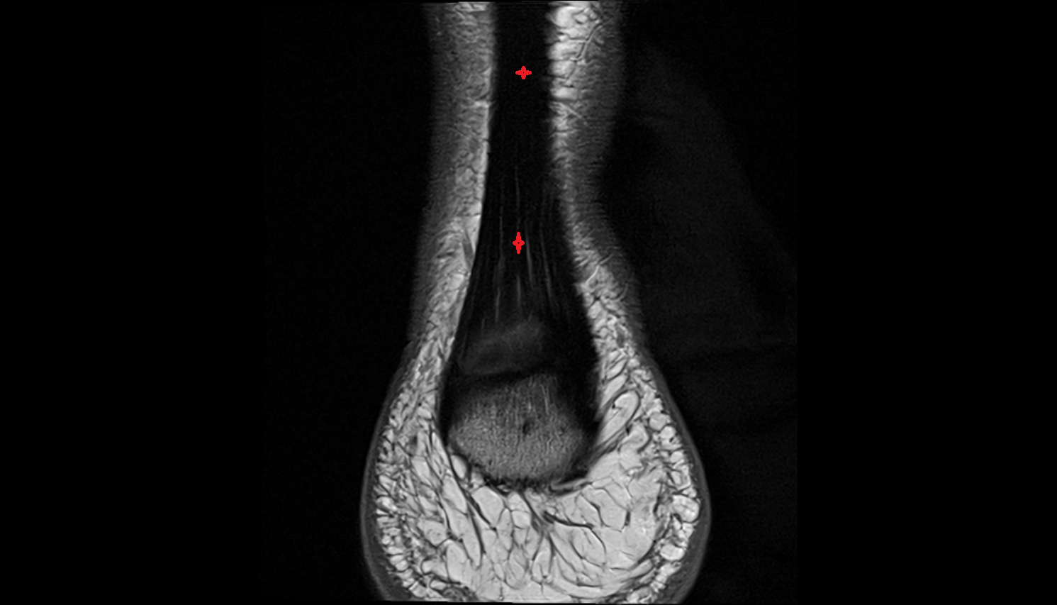 Achilles’ Tendon (Calcaneal Tendon)   coronal cross sectional anatomy 3T MRI AI enhanced radiology image-img-00000-00000_00003
