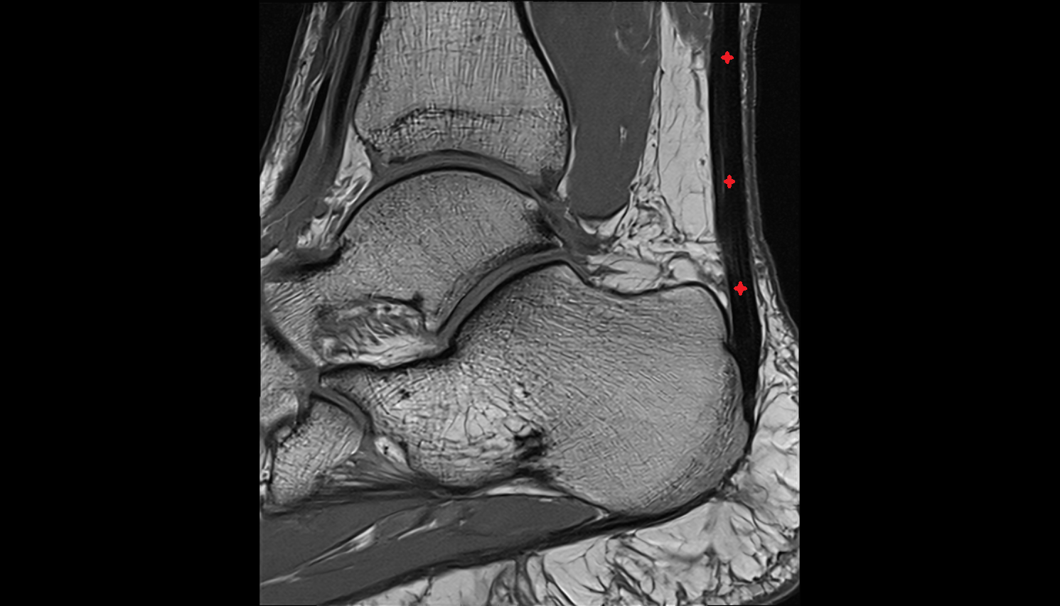 Achilles’ Tendon (Calcaneal Tendon)   sag cross sectional anatomy 3T MRI AI enhanced radiology image-img-00000-00000_00003