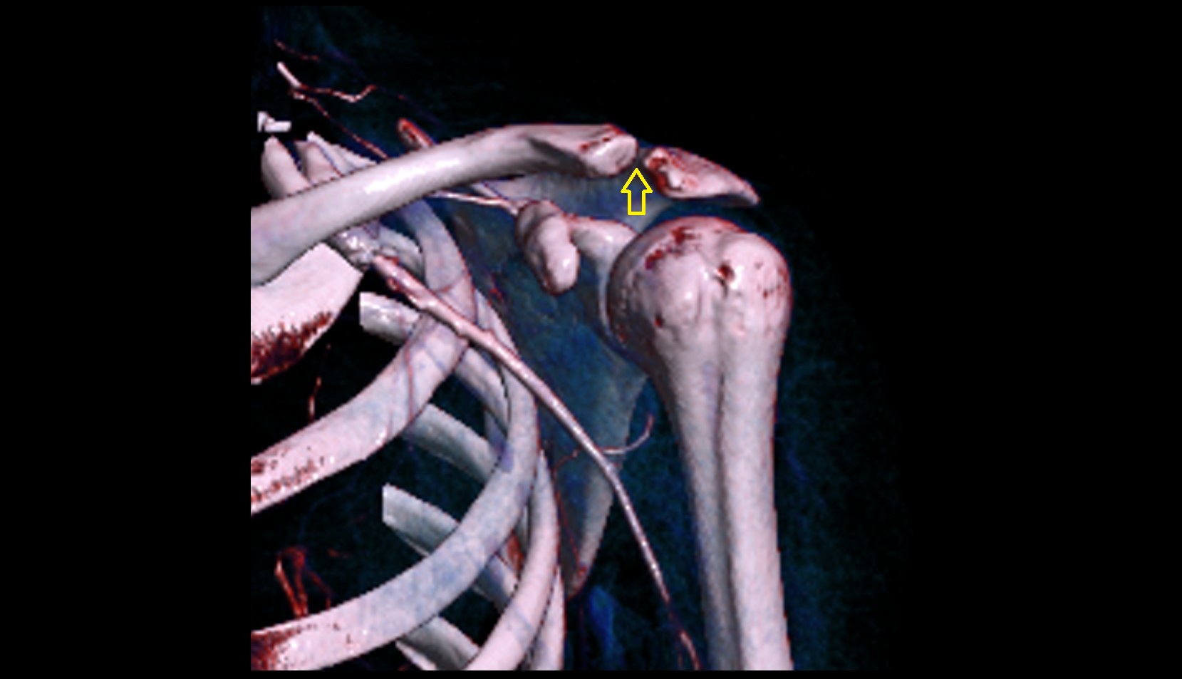 Acromioclavicular joint 3D