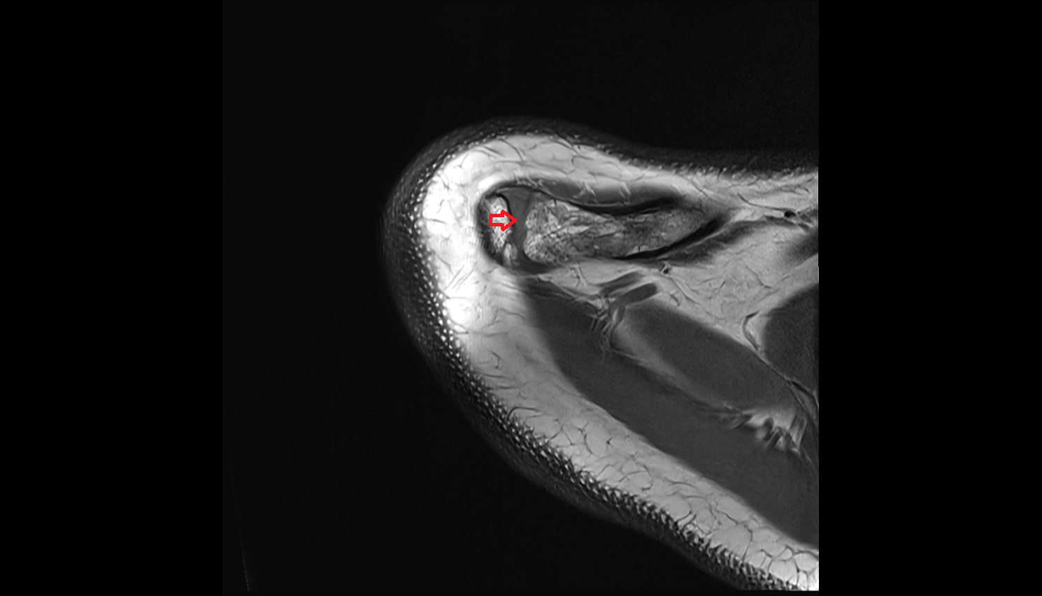 Acromioclavicular joint axial cross sectional anatomy 3T MRI AI enhanced radiology image-img-00000-00000