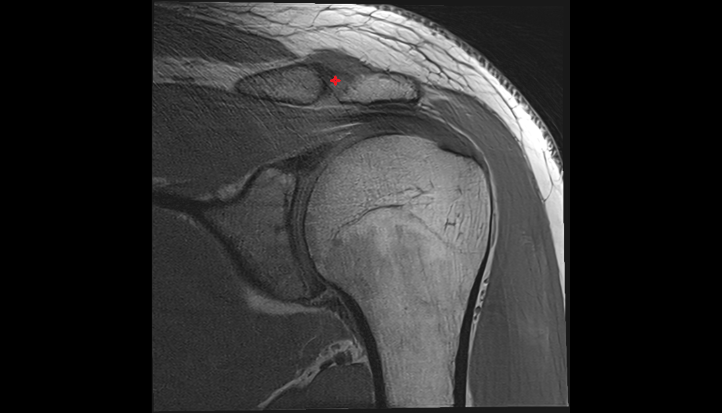 Acromioclavicular joint coronal cross sectional anatomy 3T MRI AI enhanced radiology image-img-00000-00000