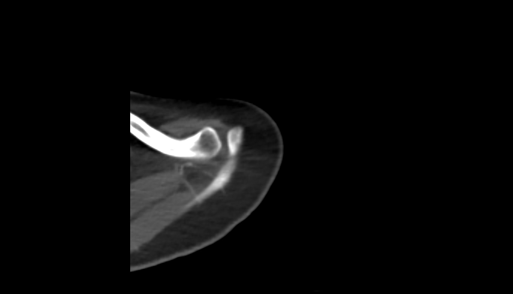 Acromioclavicular joint ct axial