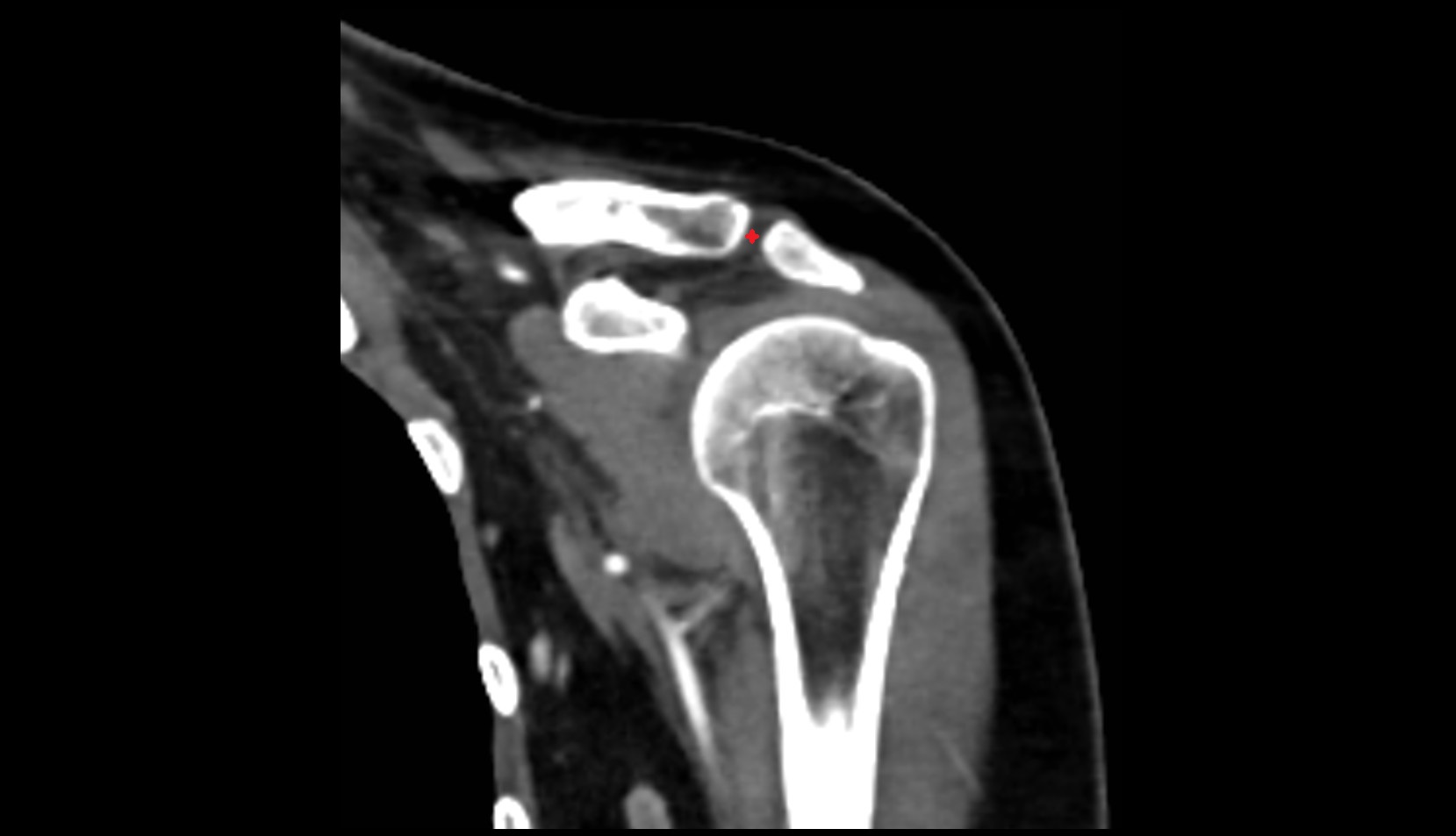 Acromioclavicular joint ct coronal