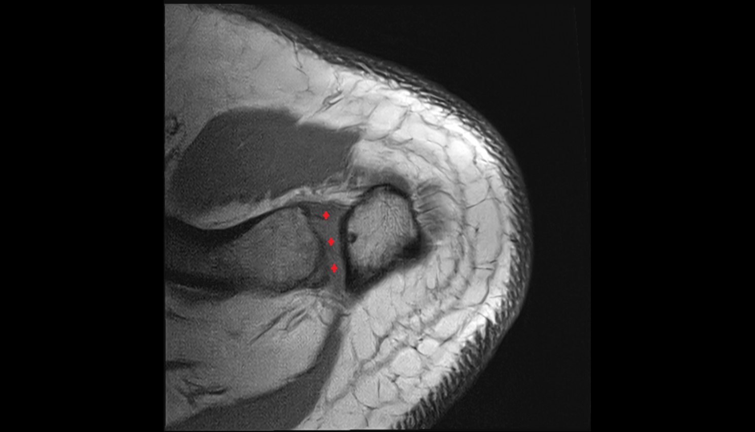 Acromioclavicular ligament  axial cross sectional anatomy 3T MRI AI enhanced radiology image-img-00000-00000