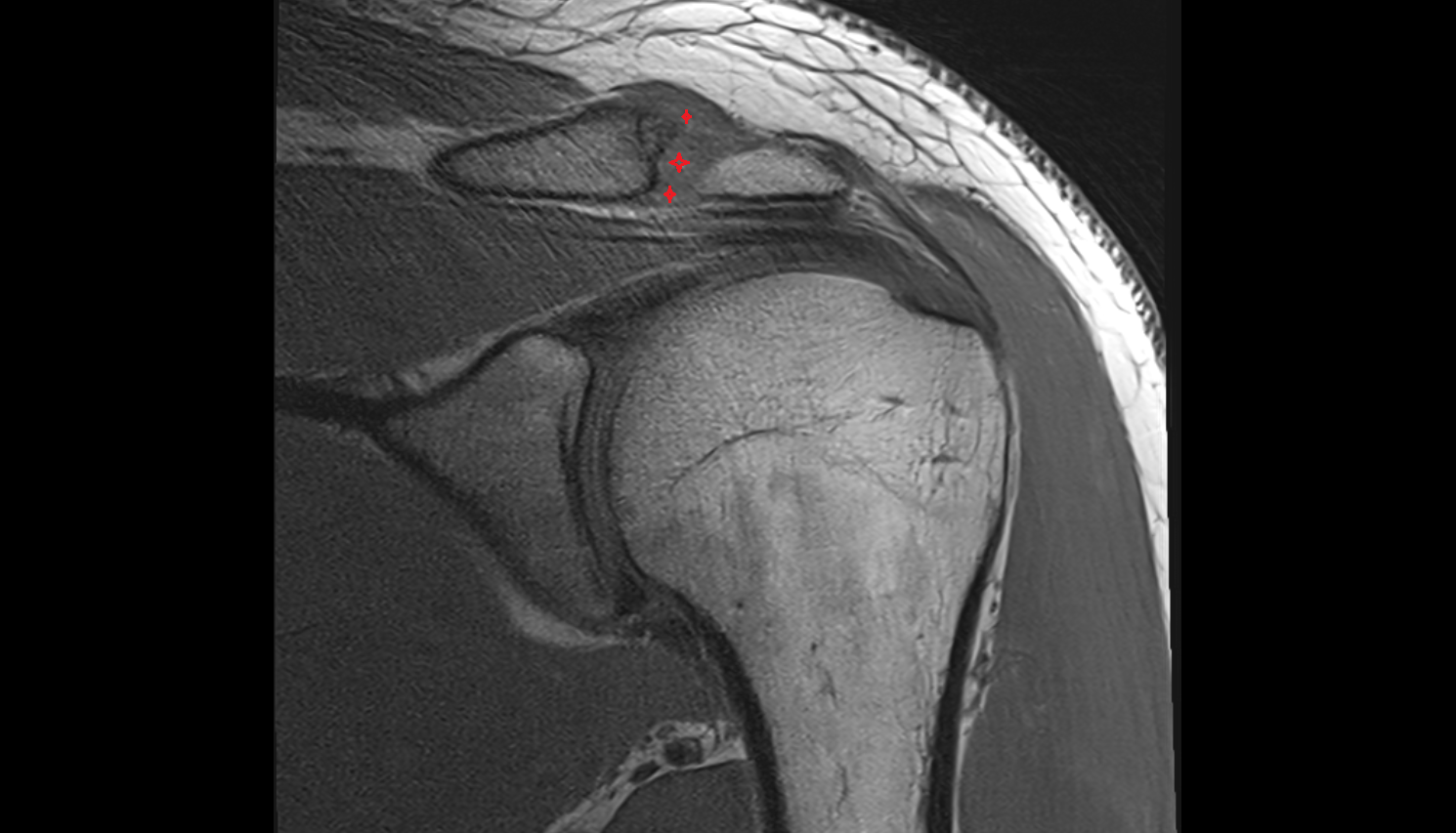 Acromioclavicular ligament  coronal cross sectional anatomy 3T MRI AI enhanced radiology image-img-00000-00000