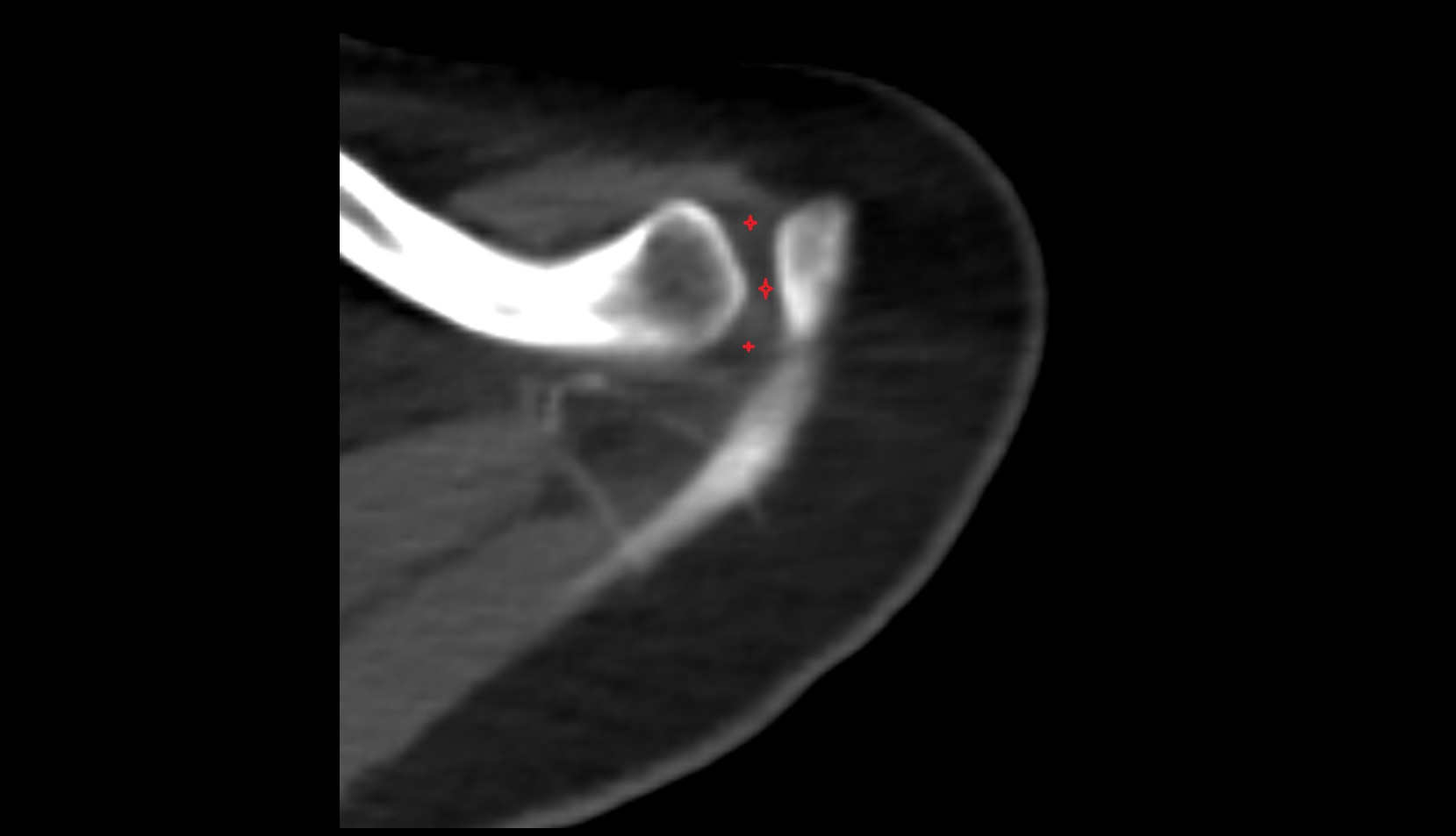 Acromioclavicular ligament ct axial image